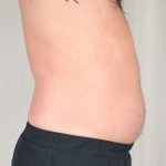 Men's Liposuction Before & After Patient #1379