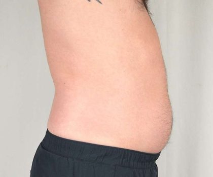 Men's Liposuction Before & After Patient #1379