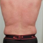 Men's Liposuction Before & After Patient #1384
