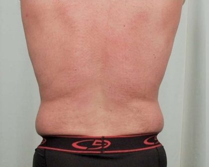 Men's Liposuction Before & After Patient #1384