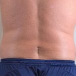 Men's Liposuction Before & After Patient #1389