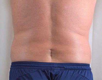 Men's Liposuction Before & After Patient #1389