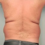 Men's Liposuction Before & After Patient #1396