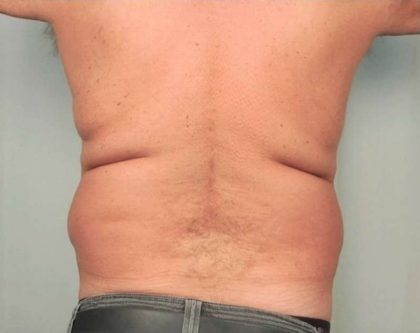 Men's Liposuction Before & After Patient #1396