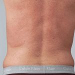 Men's Liposuction Before & After Patient #1401