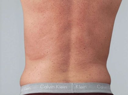 Men's Liposuction Before & After Patient #1401