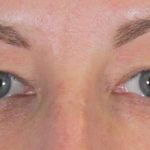 Eye Lift Before & After Patient #1408