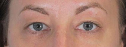Eye Lift Before & After Patient #1408