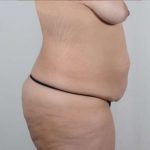 Tummy Tuck Before & After Patient #201