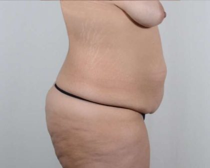 Tummy Tuck Before & After Patient #201