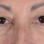Eye Lift Before & After Patient #1411
