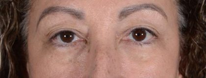 Eye Lift Before & After Patient #1411