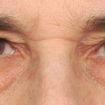Eye Lift Before & After Patient #1414