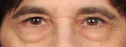 Eye Lift Before & After Patient #1414