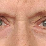 Eye Lift Before & After Patient #1417