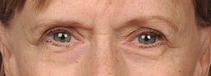 Eye Lift Before & After Patient #1417