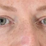 Eye Lift Before & After Patient #1420