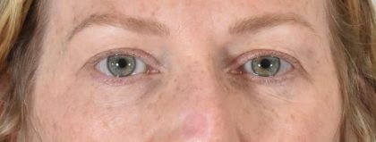 Eye Lift Before & After Patient #1420