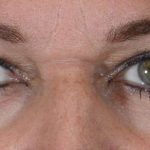 Eye Lift Before & After Patient #1423