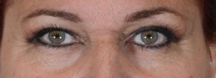 Eye Lift Before & After Patient #1423