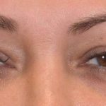 Eye Lift Before & After Patient #1426