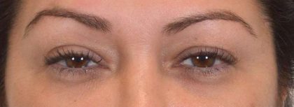 Eye Lift Before & After Patient #1426