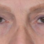 Eye Lift Before & After Patient #1429