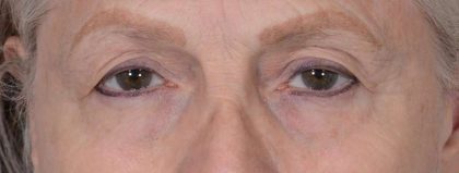 Eye Lift Before & After Patient #1429