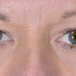 Eye Lift Before & After Patient #1432