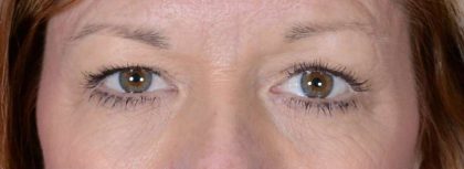 Eye Lift Before & After Patient #1432
