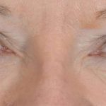 Eye Lift Before & After Patient #1435