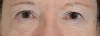 Eye Lift Before & After Patient #1435