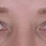 Eye Lift Before & After Patient #1438