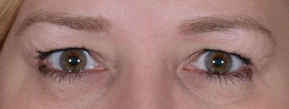 Eye Lift Before & After Patient #1438
