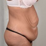 Tummy Tuck Before & After Patient #206