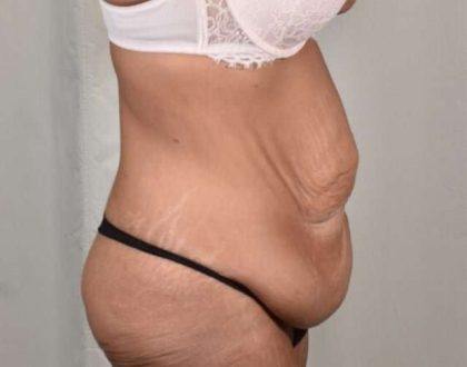 Tummy Tuck Before & After Patient #206