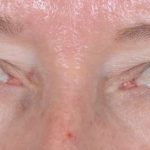 Eye Lift Before & After Patient #1441
