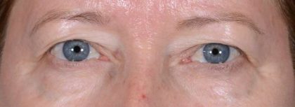 Eye Lift Before & After Patient #1441