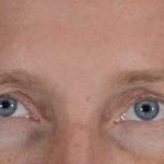 Men's Eye Lift Before & After Patient #1444