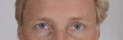 Men's Eye Lift Before & After Patient #1444