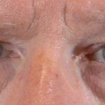 Men's Eye Lift Before & After Patient #1447