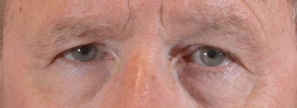 Men's Eye Lift Before & After Patient #1447