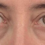 Men's Eye Lift Before & After Patient #1450
