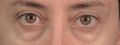 Men's Eye Lift Before & After Patient #1450