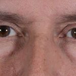 Men's Eye Lift Before & After Patient #1453