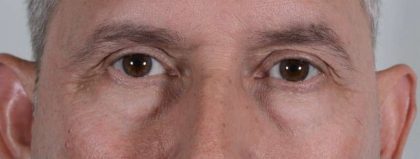 Men's Eye Lift Before & After Patient #1453