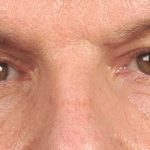 Men's Eye Lift Before & After Patient #1456