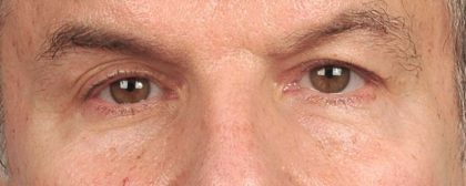 Men's Eye Lift Before & After Patient #1456