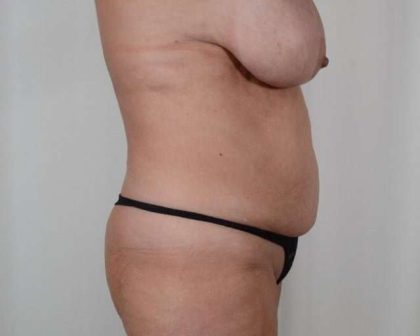 Tummy Tuck Before & After Patient #211