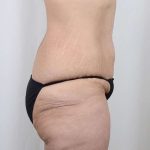Tummy Tuck Before & After Patient #221